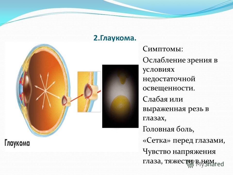 Глаукома это. Нарушения зрения глаукома. Презентация на тему глаукома.