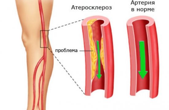 Атеросклероз