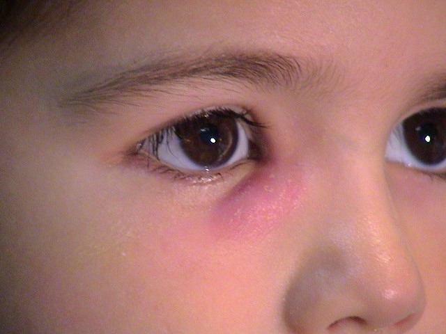 Ребенок температура слезятся глаза. Дакриоцистит дакриоаденит офтальмология. Дакриоцистит осложнения конъюнктивит. Бактериальный дакриоцистит.