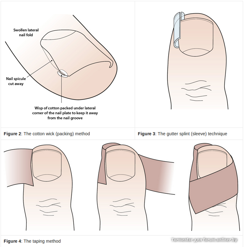Как правильно подстричь вросший ноготь на ноге в домашних условиях