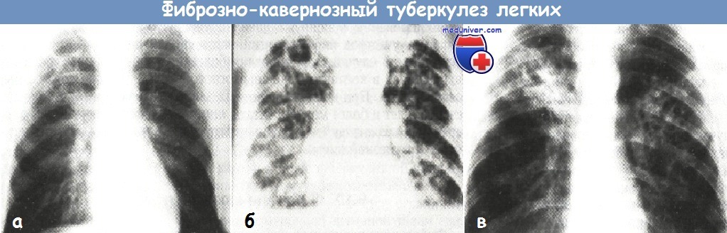 Легочный рисунок деформирован за счет пневмосклероза