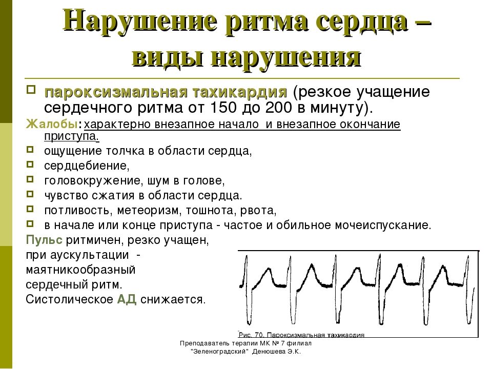 Блок схема аритмии сердца