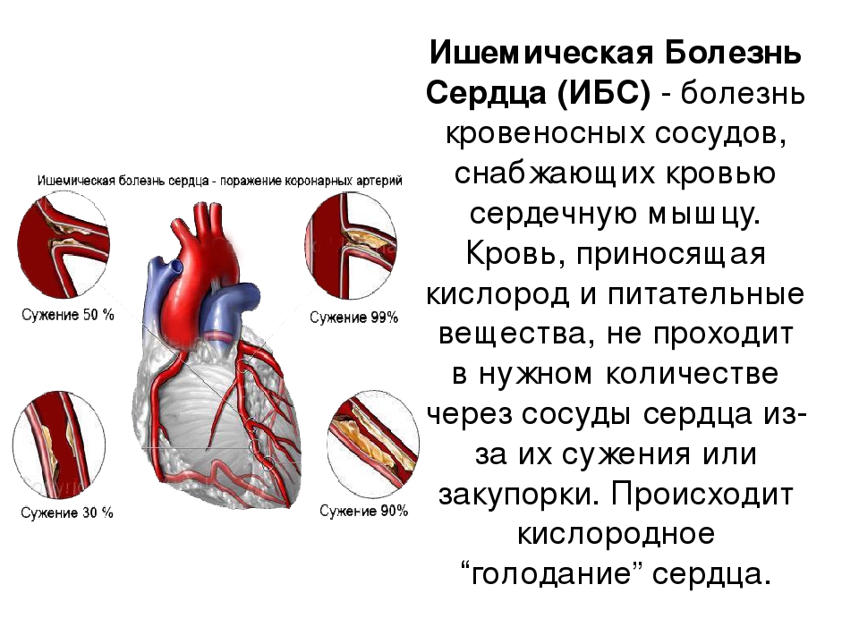 Ишемия сердца признаки. Сосуды сердца. Ишемическая болезнь сердца. Заболевания коронарных сосудов. Сосудистые заболевания сердца.