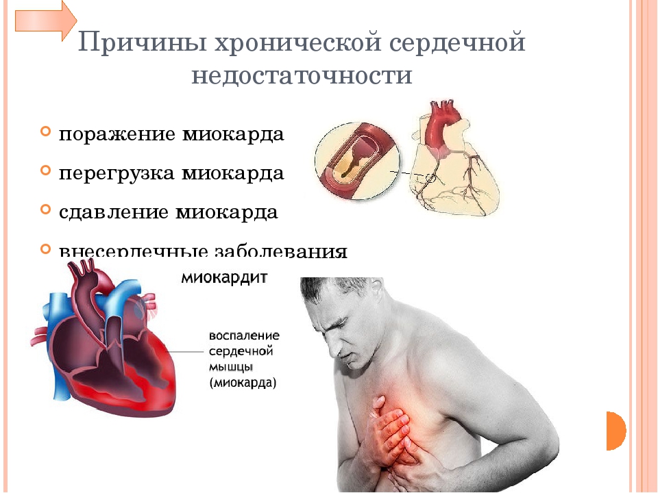 Поражение сердца без застойной сердечной недостаточности. Профилактика острой сердечной недостаточности. Хроническая сердечная недостаточность факторы. Причины развития хронической сердечной недостаточности. Профилактика хронической сердечной недостаточности.