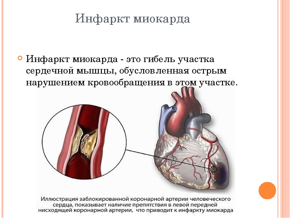 Гемофилия цинга инфаркт миокарда