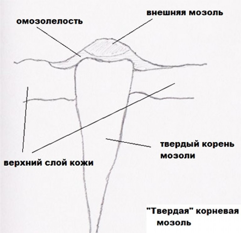 Стержневая Мозоль Фото И Лечение