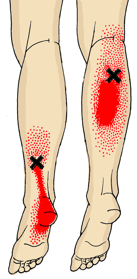 Болит нога после. Триггерные точки икроножной мышцы. Триггерные точки мышц голени. Триггерные точки мышц стопы. Триггерные точки мышц стопы и голени.