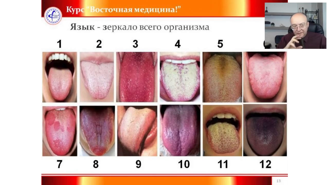 Как определить заболевание по языку картинки