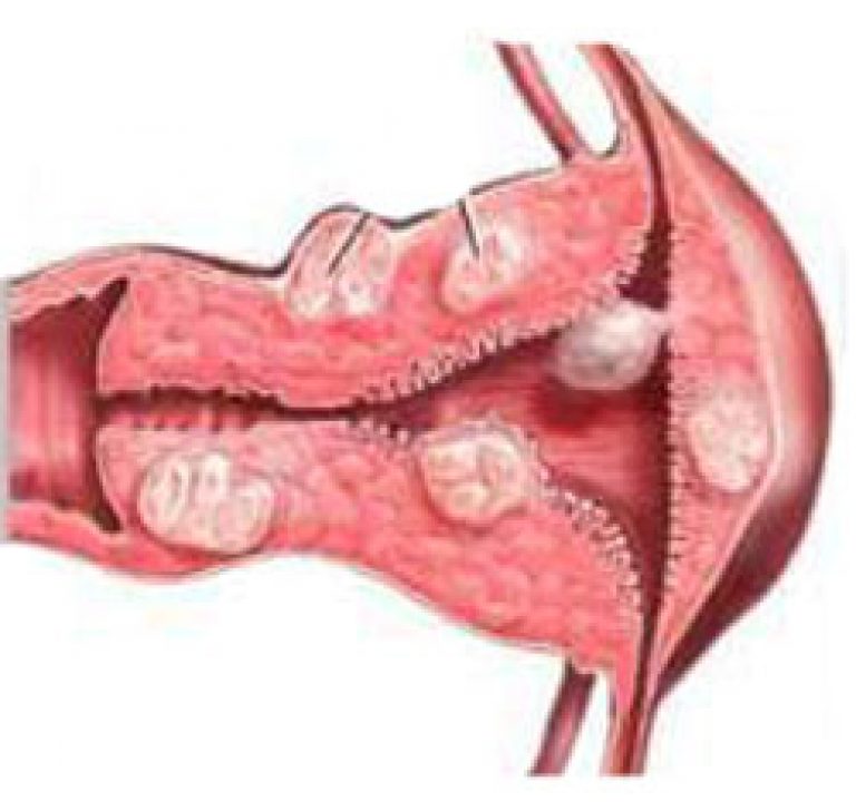 Внутреннее воспаление матки. Железисто-фиброзный эндометриальный полип. Аденоматозный полип эндометрия. Малигнизация полипа шейки матки.