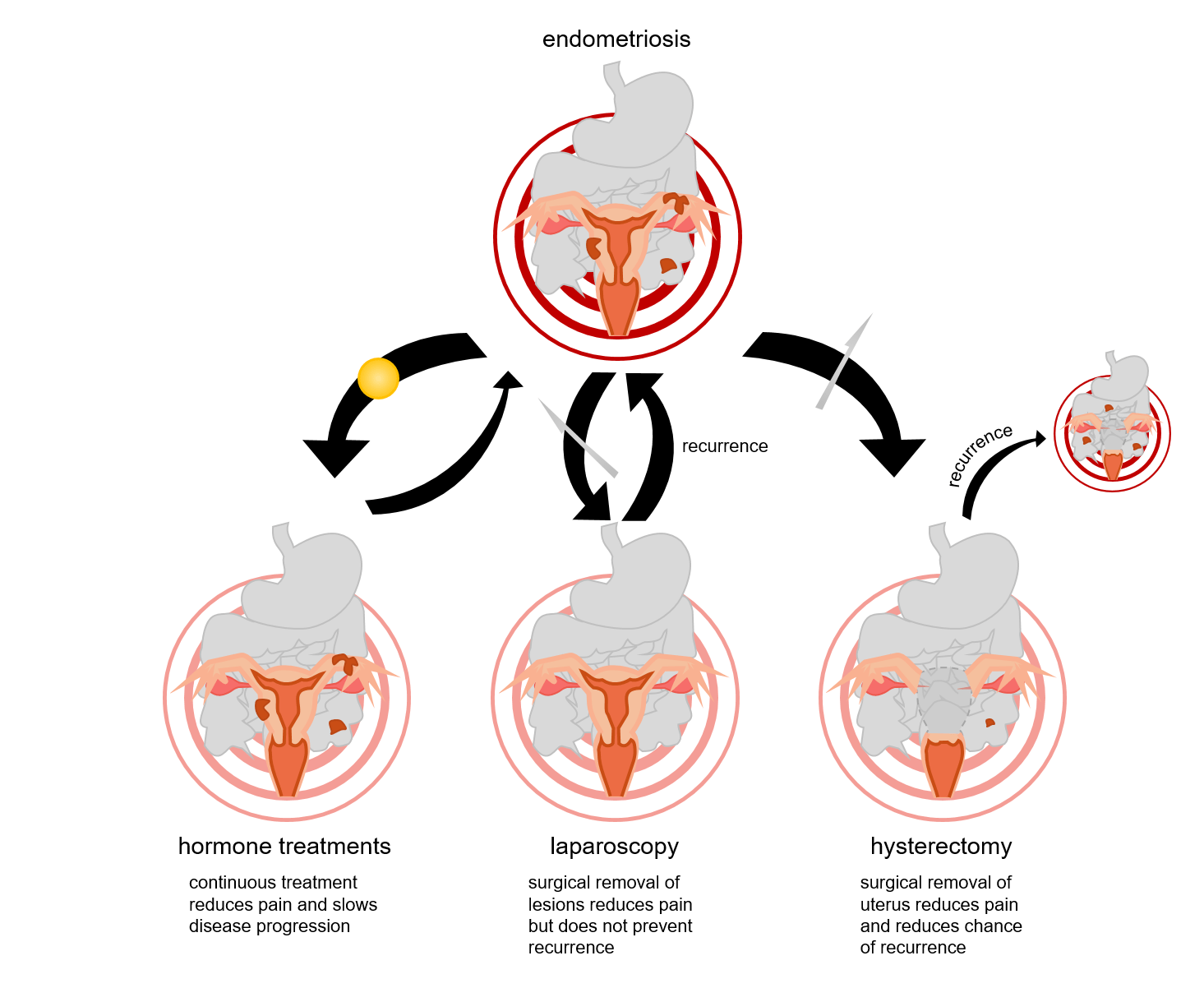 Embarazo endometriosis
