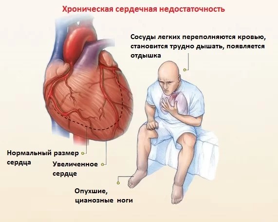 Острая сердечная недостаточность картинки