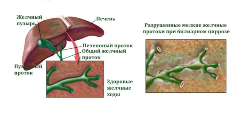 Желчный пузырь и печень признаки. Первичный билиарный цирроз печени препарат. Печень внутрипеченочные желчные протоки анатомия. Внутрипеченочные желчные протоки гистология. Пузырный проток желчного.