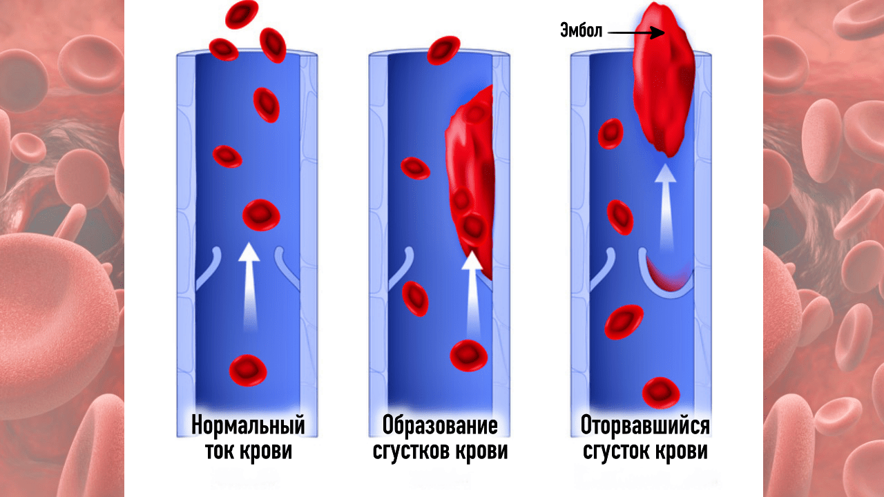 Эмболия тромбы. Тромбоз кровеносных сосудов.