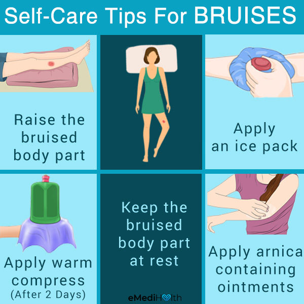 care tips for bruises