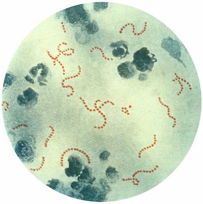 Наиболее частая причина ангины - бактерии, в том числе стрептококк