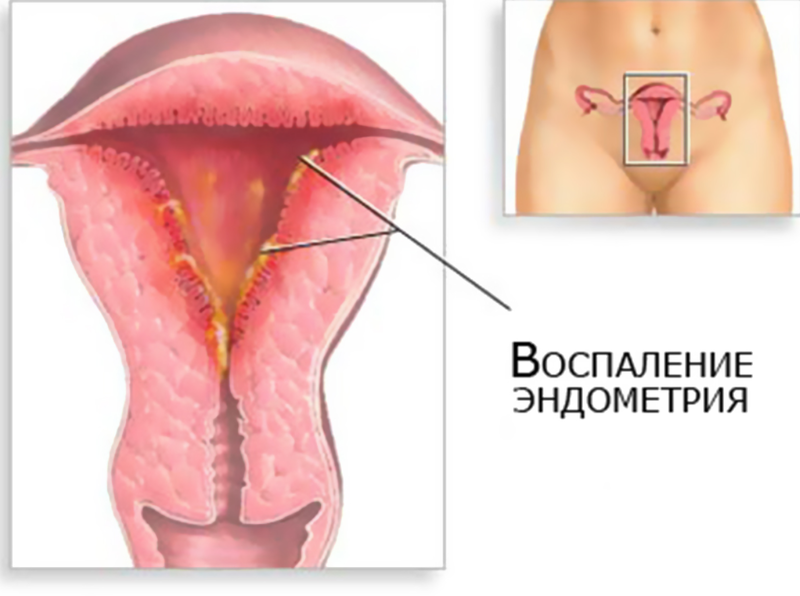 Симптомы и лечение эндометрита