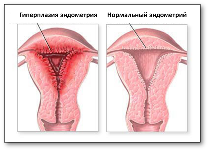 Симптомы эндометрита