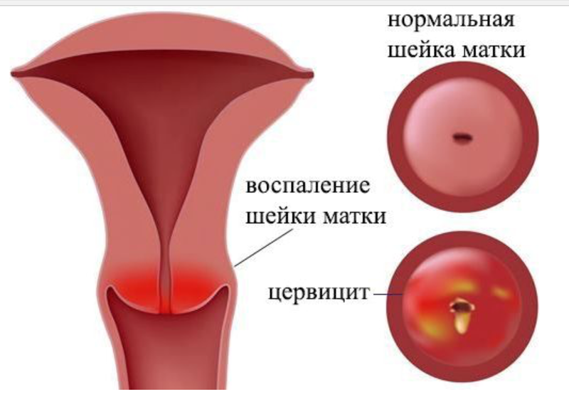 Основные причины и первые признаки эндометрита