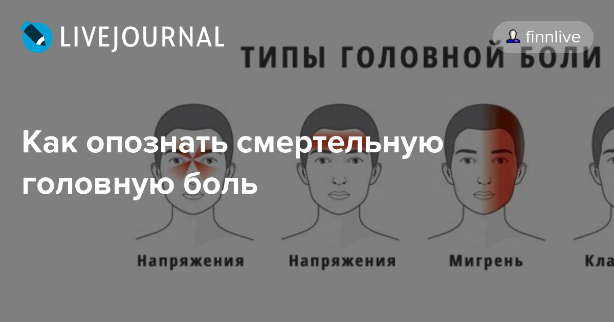 Виды головных болей в картинках