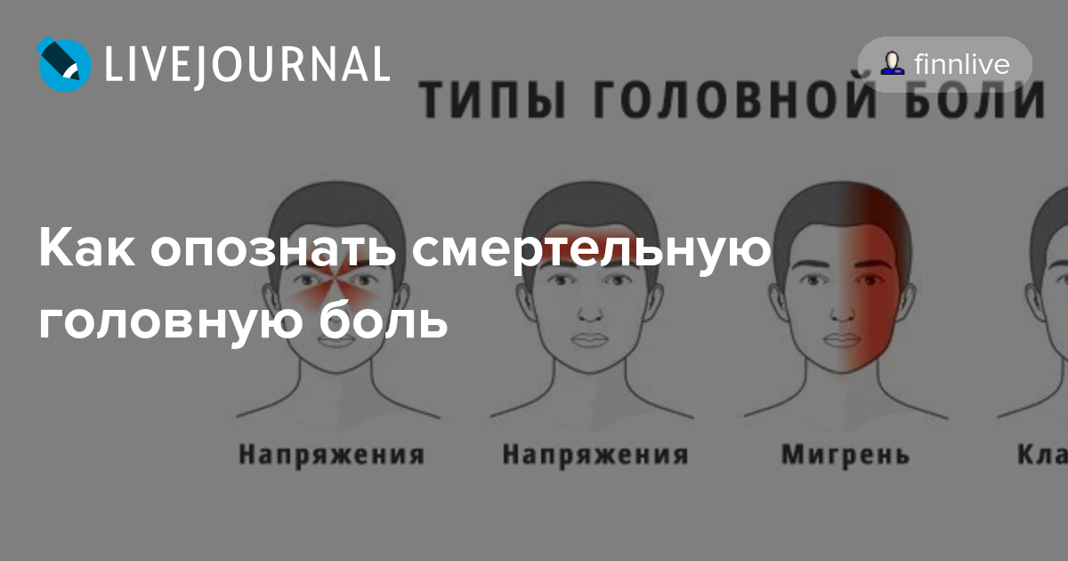 Виды головной боли в картинках и их названия