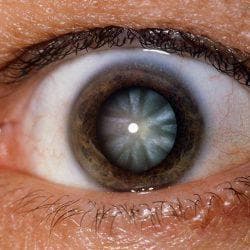 признаки глаукомы глаза