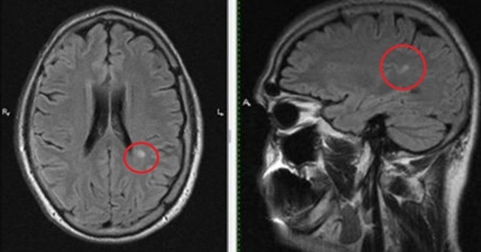 Рассеянный склероз фото больных до и после