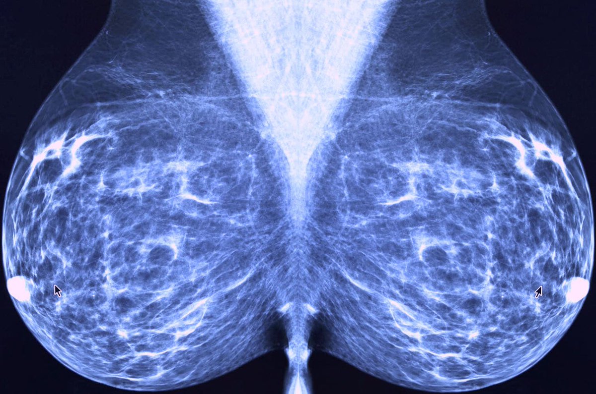 как делают маммографию груди у женщин фото 112