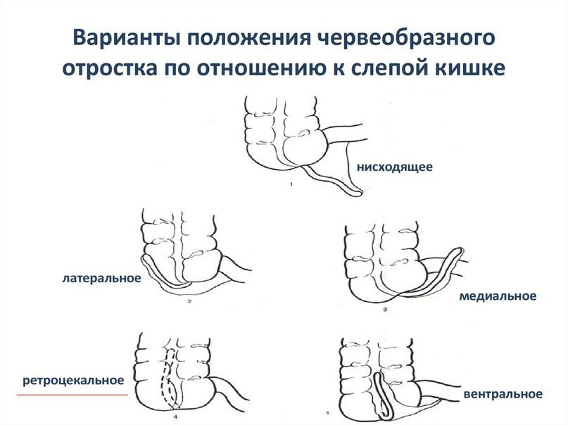 Аппендикс расположение схема