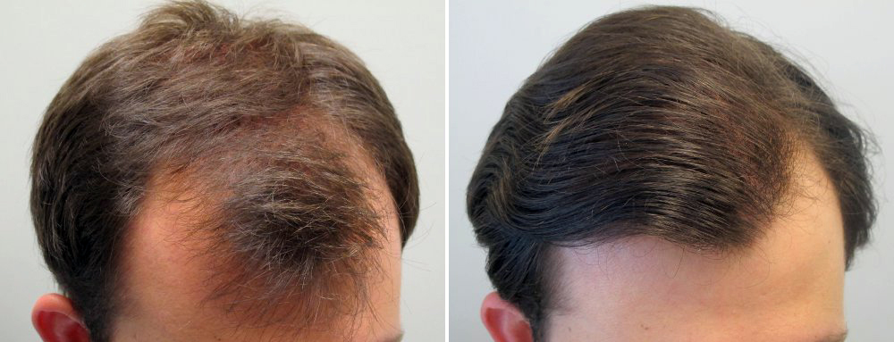Помогает ли миноксидил при диффузном выпадении волос