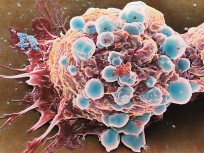 Раковые клетки при увеличении