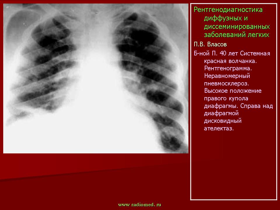 Диффузный пневмосклероз это рак. Системная красная волчанка лёгких рентген. Диссеминированных заболеваний легких. Рентгенодиагностика заболеваний легких.