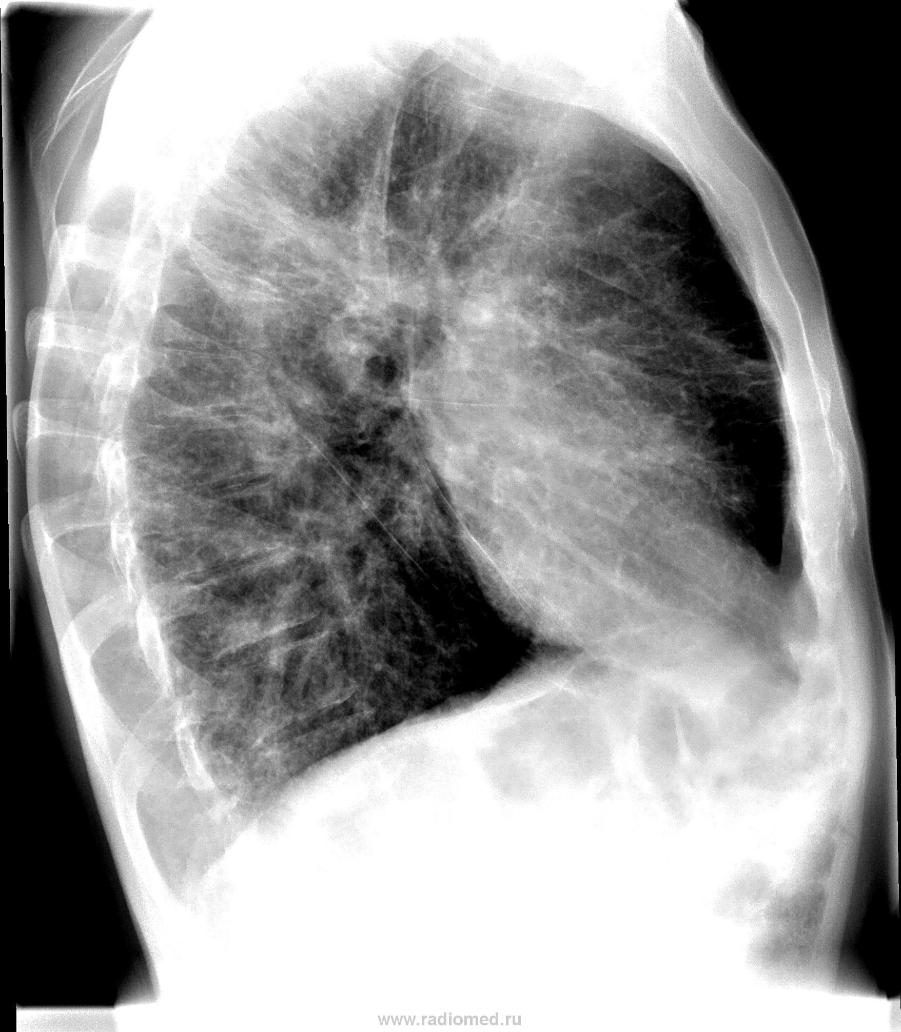 Диффузный пневмосклероз это рак. Диффузный пневмосклероз рентген. Узелковый пневмосклероз. Посттуберкулёзный пневмосклероз.