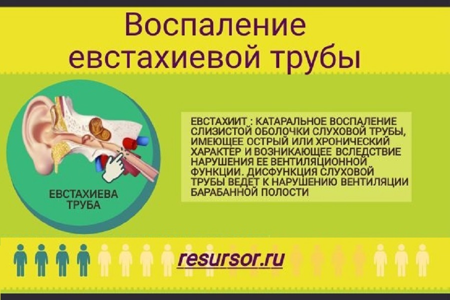 Воспаление труб. Дисфункция слуховой трубы симптомы. Воспаление слуховой трубы. Дисфункция евстахиевой трубы. Воспаление евстахиевой трубы.