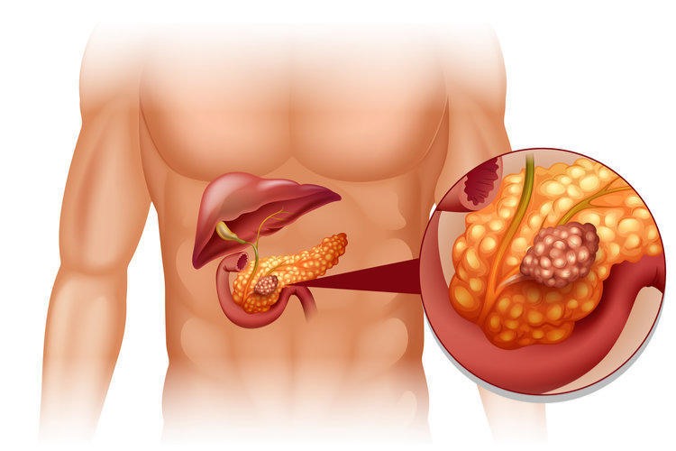 Опухоль поджелудочной железы