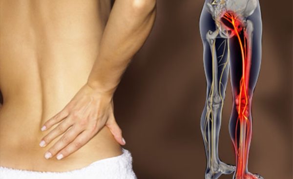 Главный признак ишиаса – сильная боль в области спины