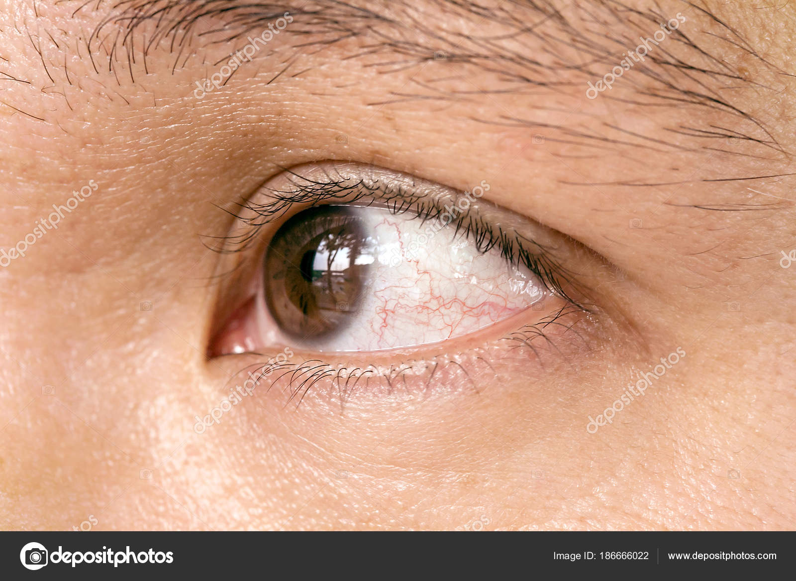 Воспаление капилляров в глазах