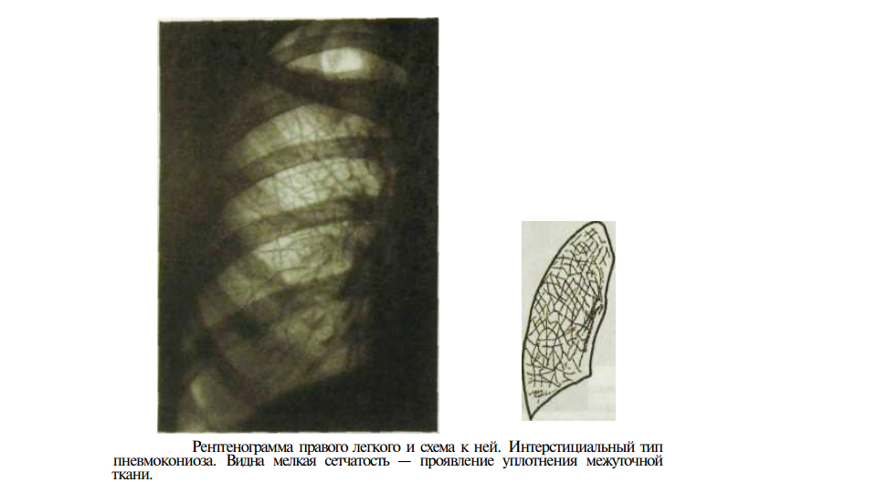 Легочный рисунок с признаками пневмосклероза что