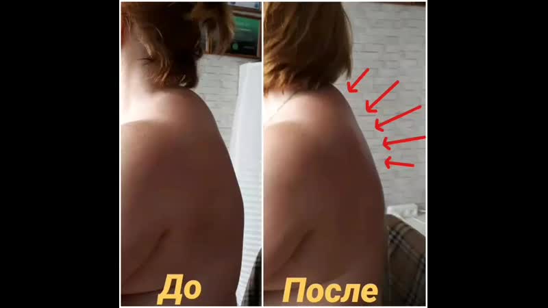 Как скрыть горб на спине с помощью одежды