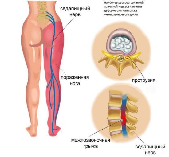 Ущемление седалищного нерва