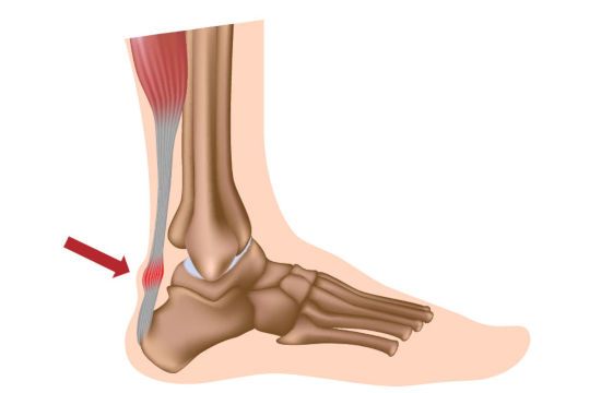 Воспаление ахиллова сухожилия