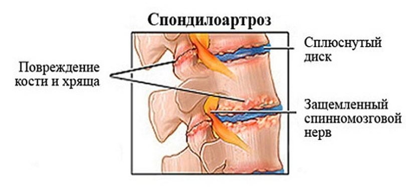 Спондилоартроз 