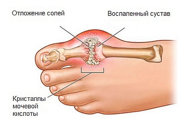 Подагрический артрит