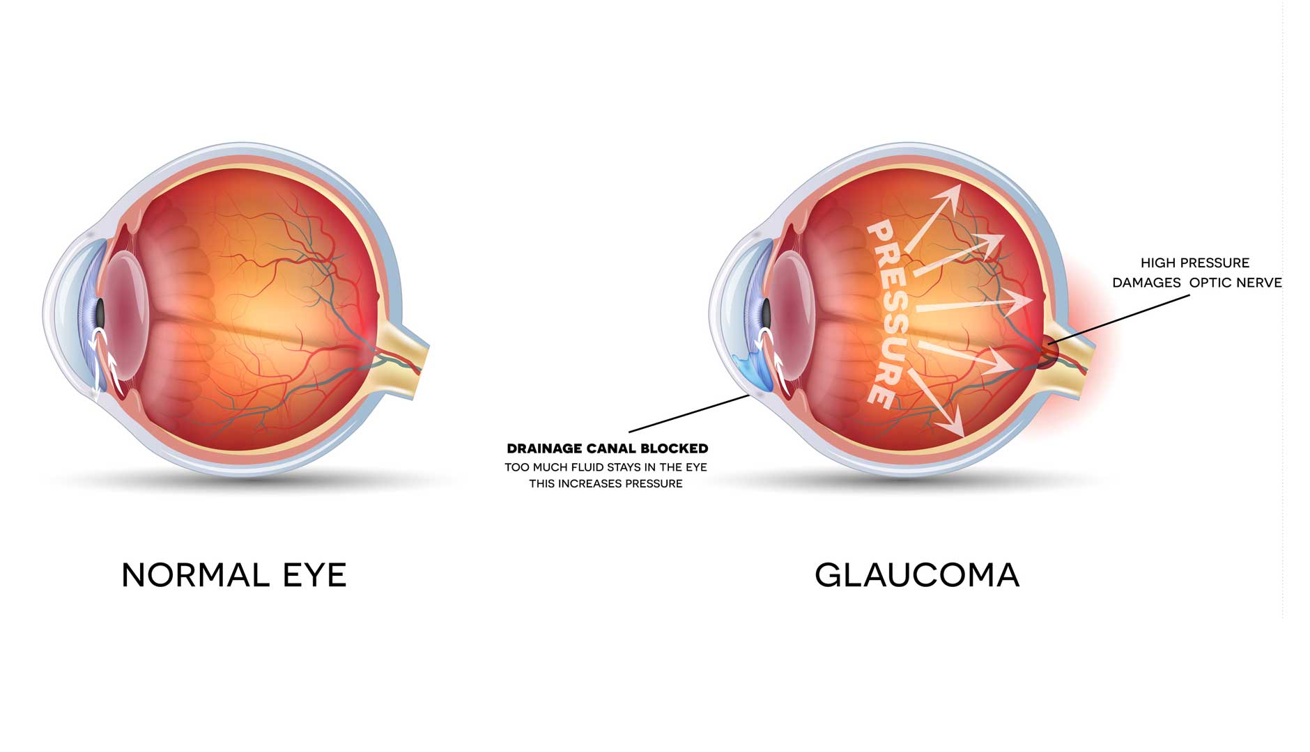 Глазное давление при катаракте. Внутриглазное давление глаукома.