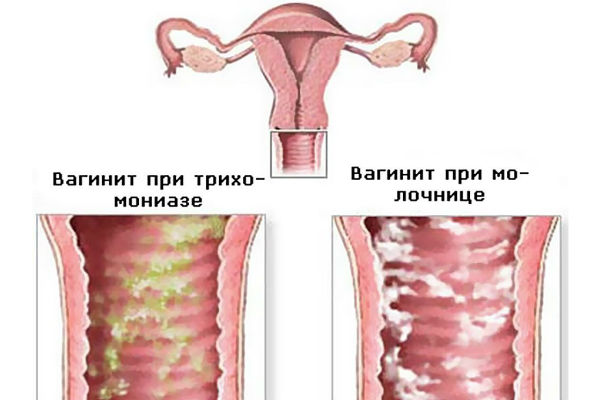 вагинит
