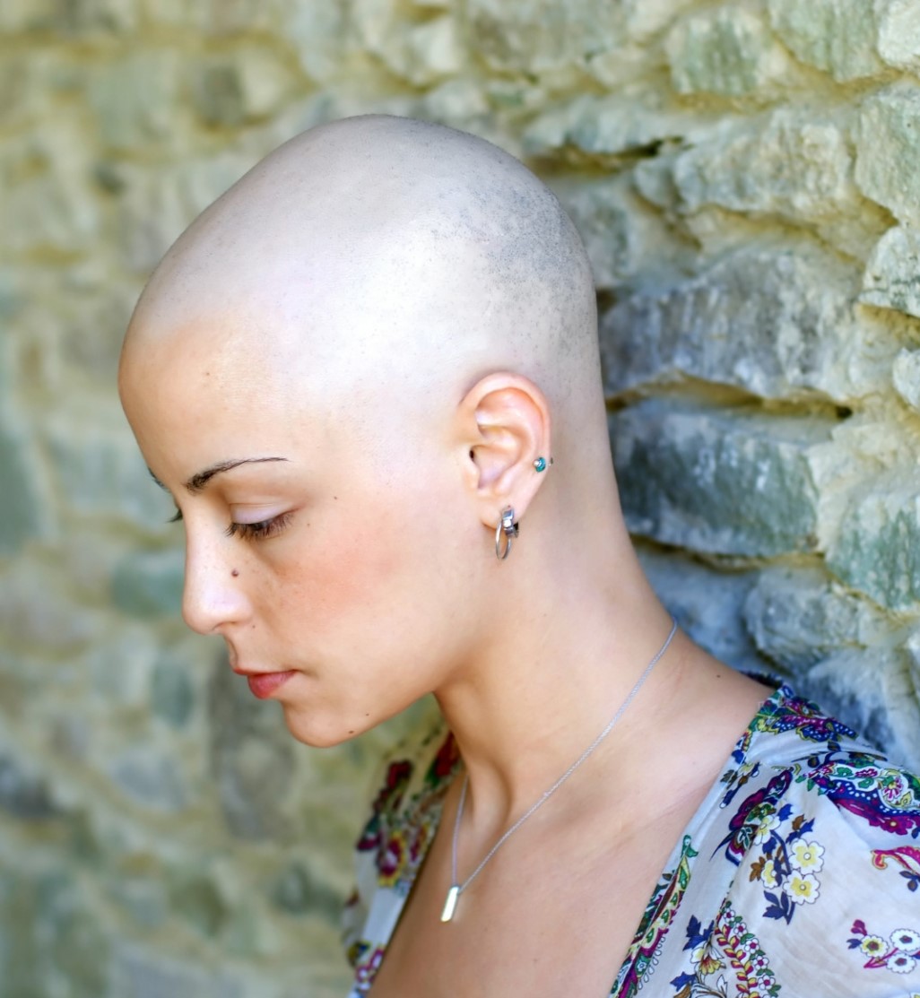 волосы после химиотерапии через год фото
