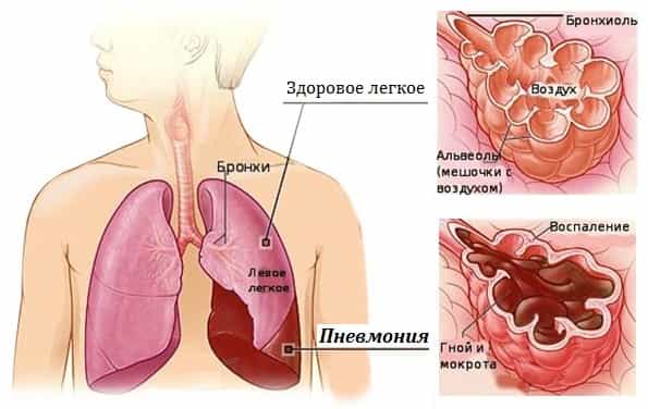 Пневмосклероз легких в пожилом возрасте что это и как лечить фото