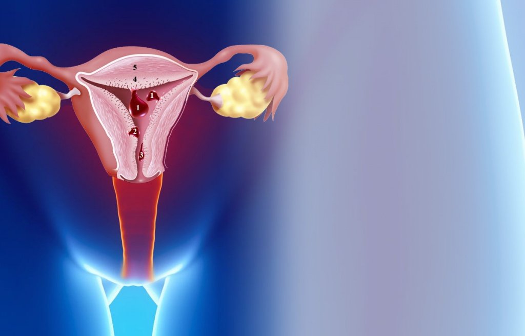 Как часто полипы матки перерождаются в рак