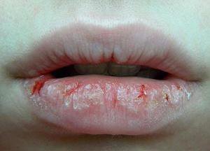 Сухость и потресканные губы при болезнях ЖКТ