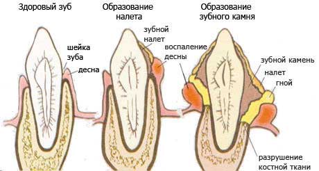 Твердые отложения на зубах появляются от плохой гигиены