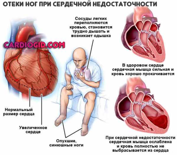 Как определить сердечную недостаточность у женщин – Симптомы сердечной